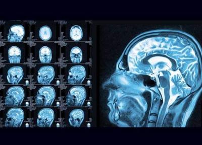آنالیز خطر سکته مغزی بر اثر ابتلا به کووید 19
